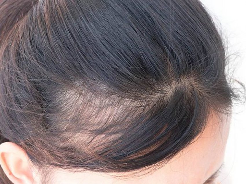 A është rënia e flokëve problem kronik?