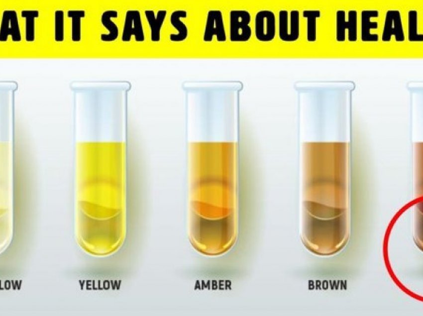 Kujdes: Nëse e keni këtë ngjyrë të urinës, urgjent tek mjeku