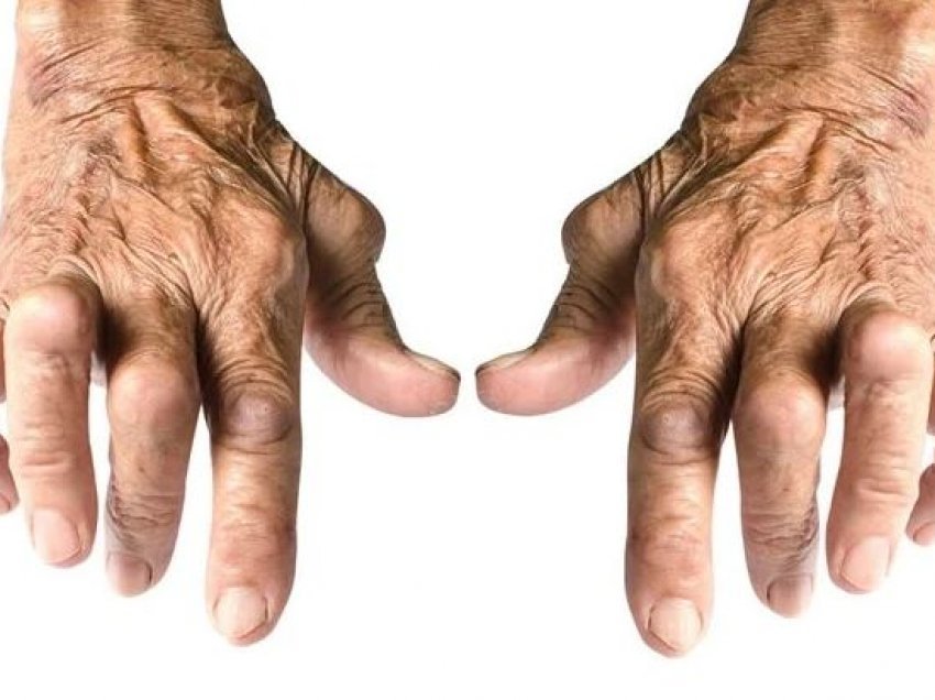 Mitet rreth sëmundjes së artritit/ Faktet interesante që duhet të dini
