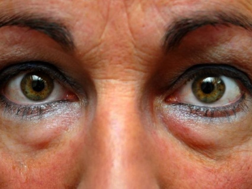 Mjekët zbulojnë faktorët që ndikojnë në formimin e rrathëve të zinj poshtë syve 
