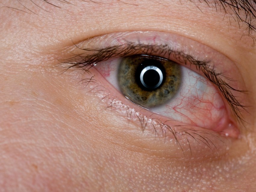 Çfarë e shkakton lodhjen e vazhdueshme të syve?