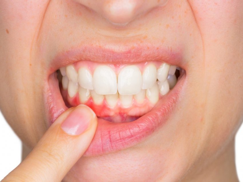 Covid-19, mishrat e përflakur të dhëmbëve rrisin rrezikun e komplikimeve