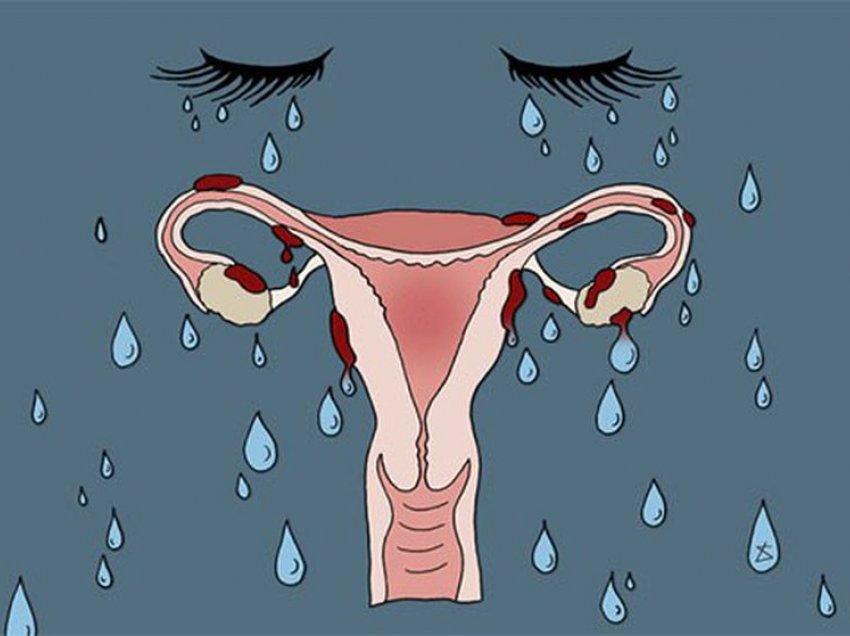 Sindroma premenstruale: Shkaqet, simptomat dhe trajtimi