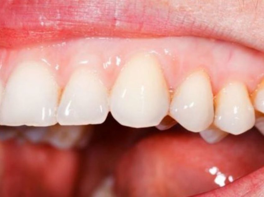 Çfarë problemi shëndetësor tregojnë mishrat e zbardhur të dhëmbëve dhe si trajtohen ato