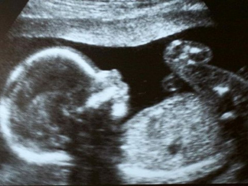 Foshnja lind me embrion në stomak