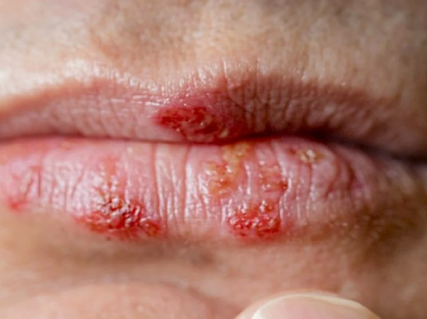 Pse shfaqet herpsesi në buzë? Metodat si ta parandaloni dhe trajtoni