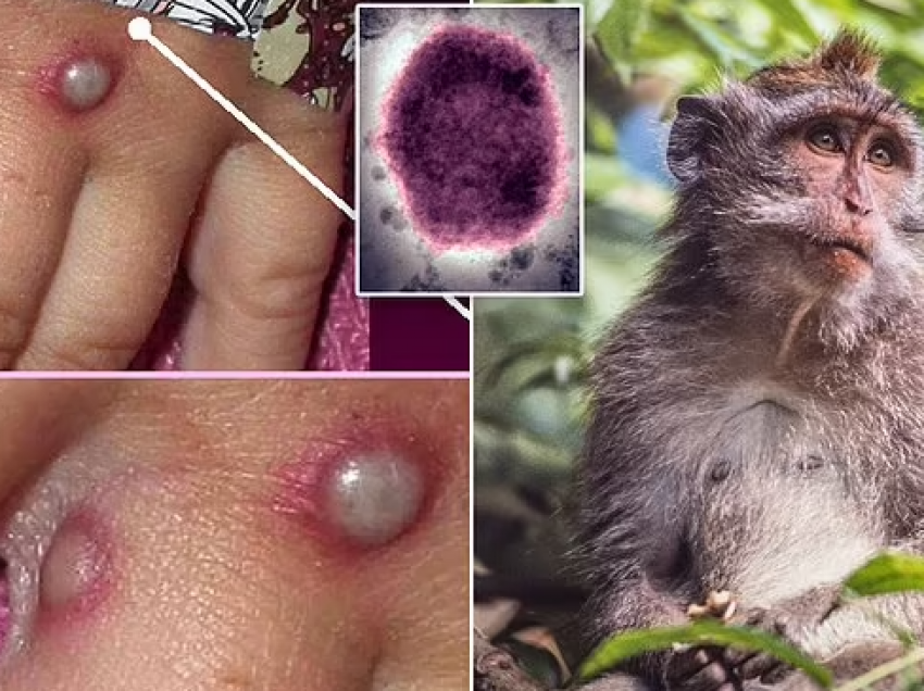 Lija e majmunit|/ Ja shenjat, të mbrojtur më shumë të vaksinuarit nga lija