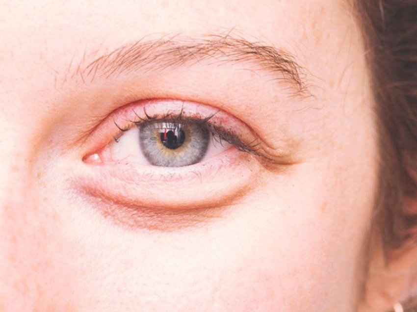 A është ngjitëse sëmundja e syrit tiroide? Njihni simptomat, shkaqet dhe parandalimin e tij