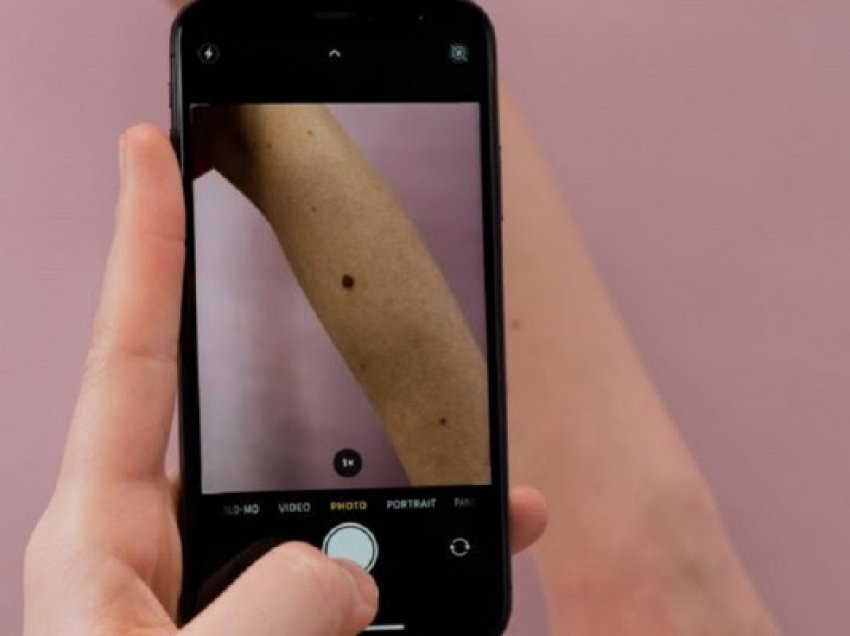 ​Kanceri i lëkurës po rrezikon adoleshentët dhe të rinjtë, metodat për ta parandaluar
