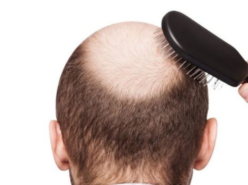 Zbulohet shërimi kundër rënies së flokëve