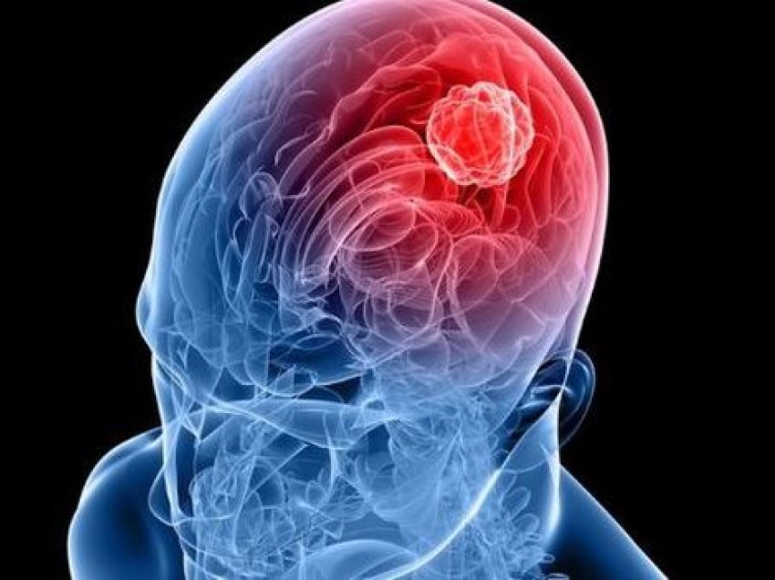 Gjashtë shenja paralajmëruese të tumorit të trurit