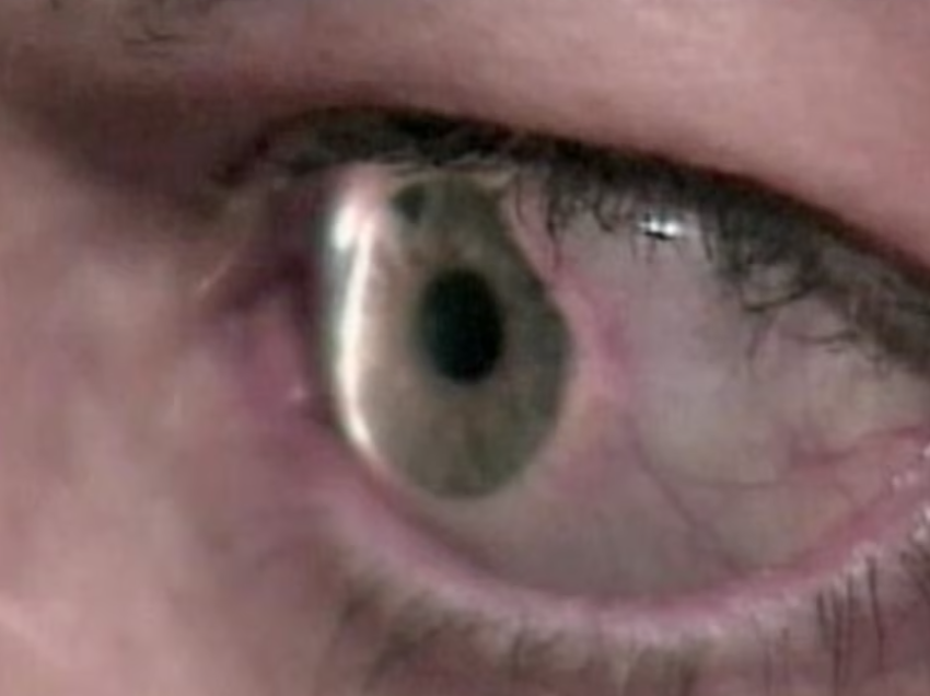 Kontrollet e rregullta të syve, mënyra më e mirë për të zbuluar shenjat e para të glaukomës
