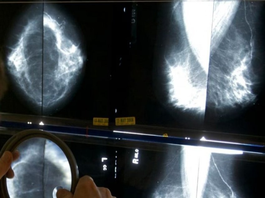 Ekspertët: Mamografia të fillojë në moshën 40 vjeçare