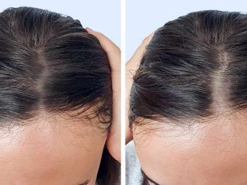 3 gabimet që na shkaktojnë rënie të flokëve