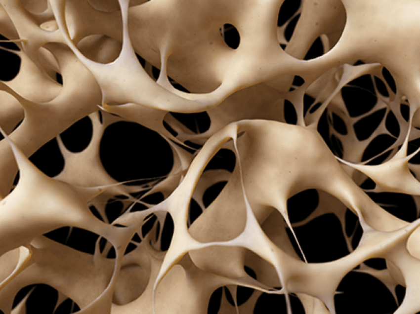 Osteoporoza – Shtohet një tjetër faktor rreziku