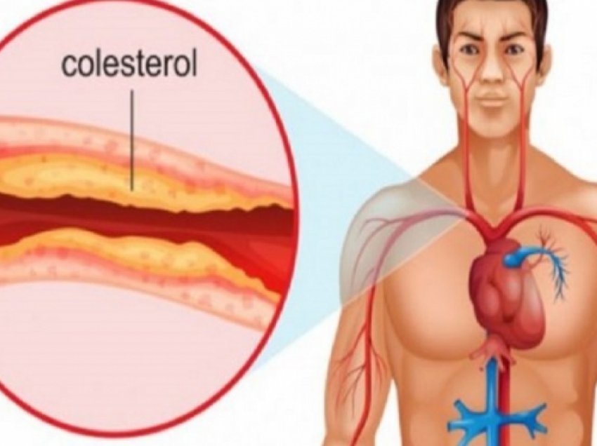 Simptomat e kolesterolit të lartë që nuk duhen neglizhuar