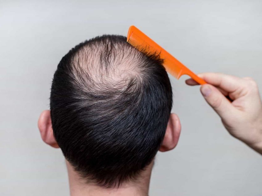 Shkencëtarët zbulojnë shkakun e rënies së flokëve tek meshkujt
