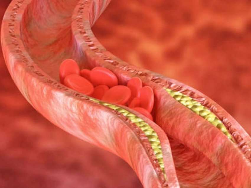 Faktorët që ndikojnë në rritjen e kolesterolit të keq