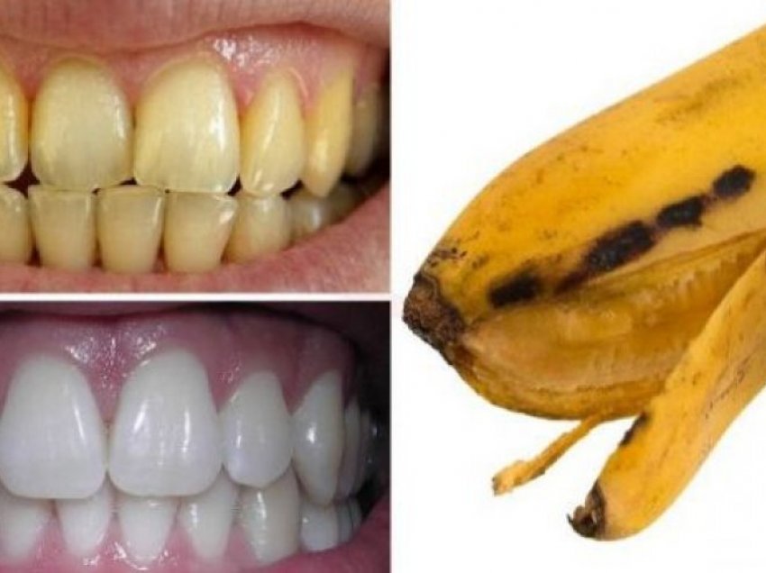 Pastroni dhëmbët me dredhëza dhe lëvore të bananes, shmangeni shpëlarjen me vaj kokosi!