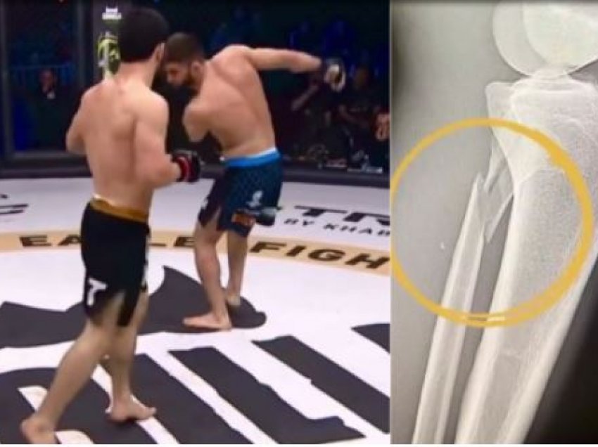 Dalin pamjet e rentgenit se si luftëtari i UFC-së theu këmbën 