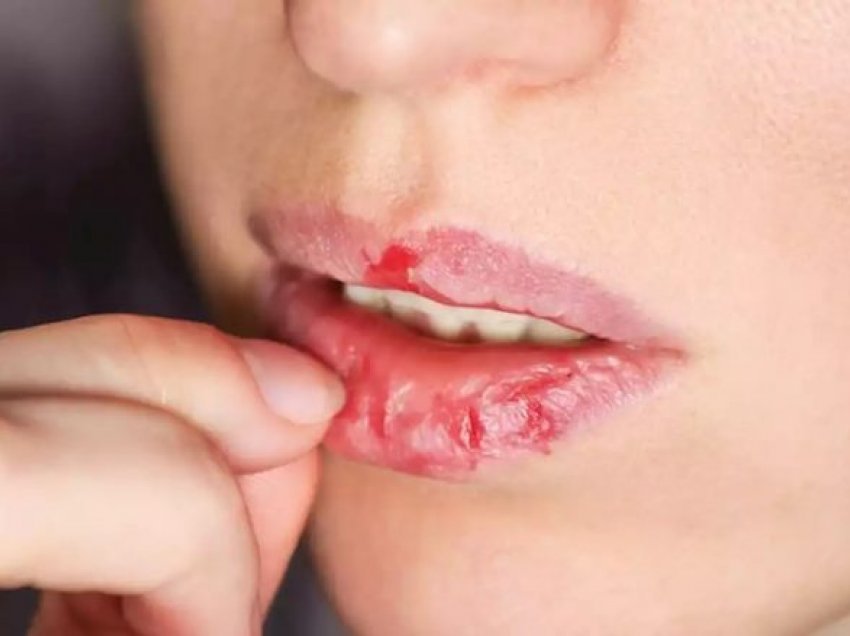 Arsyet e mundshme pse ju plasariten buzët dhe si t’ia bëni që të mos ju ndodhë më!