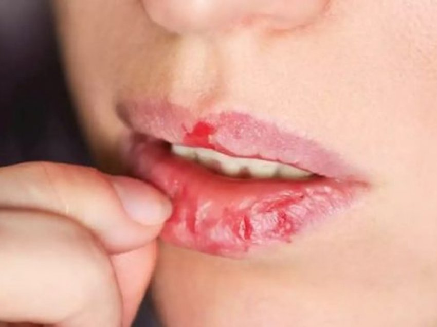 Arsyet e mundshme pse ju plasariten buzët