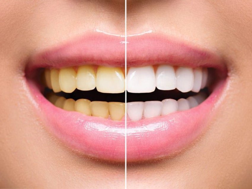 7 arsyet më të zakonshme që po ju shkaktojnë 'dhëmbë të verdhë'