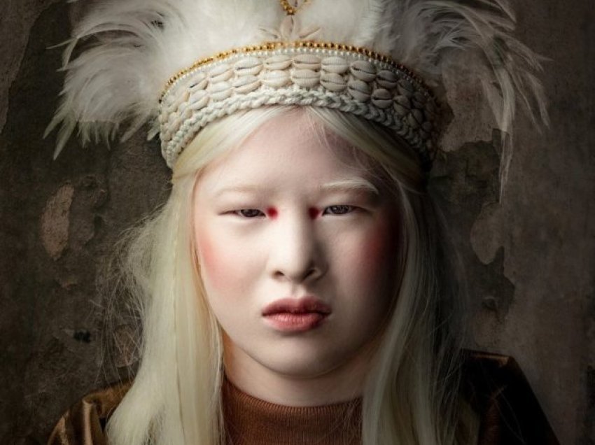 Historia e modeles së Vogue që prindërit e braktisën sepse ishte me albinizëm