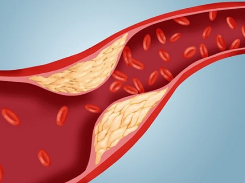 Faktorët që ndikojnë në rritjen e kolesterolit 