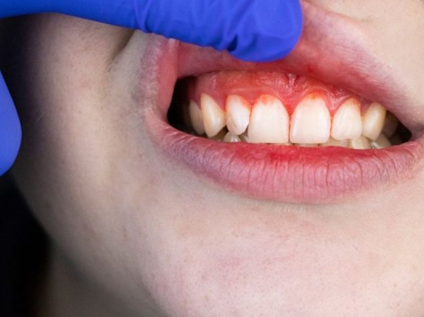 Çfarë ju tregojnë gjakderdhja dhe zmbrapsja e mishrave të dhëmbëve për shëndetin tuaj