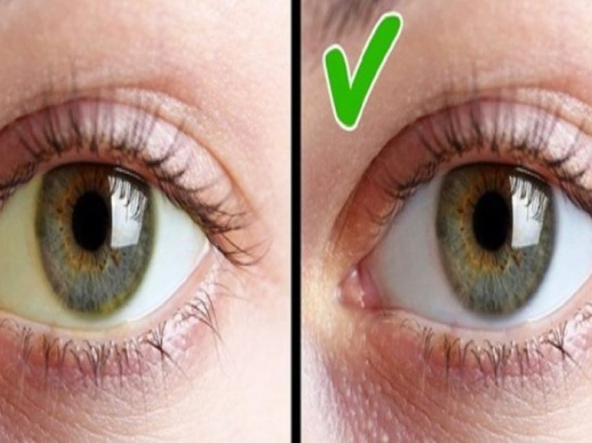 Keni mungesë të vitaminës D? Sytë tuaj i tregojnë simptomat kështu!