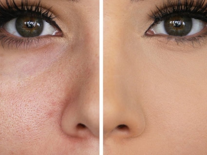 Si t’i mbyllni poret e fytyrës pa shkuar fare te dermatologu
