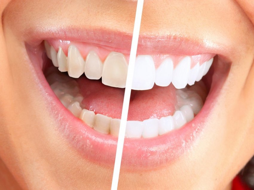 Për dhëmbë të bardhë xixë, ndiqni këto truke të thjeshta!
