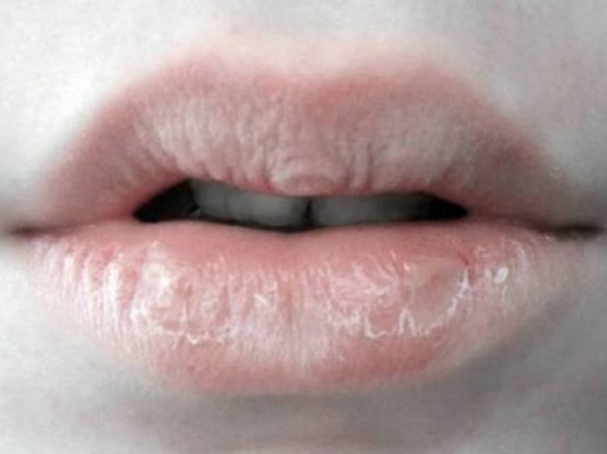 Tharjen e buzëve mund ta shëroni në shtëpi