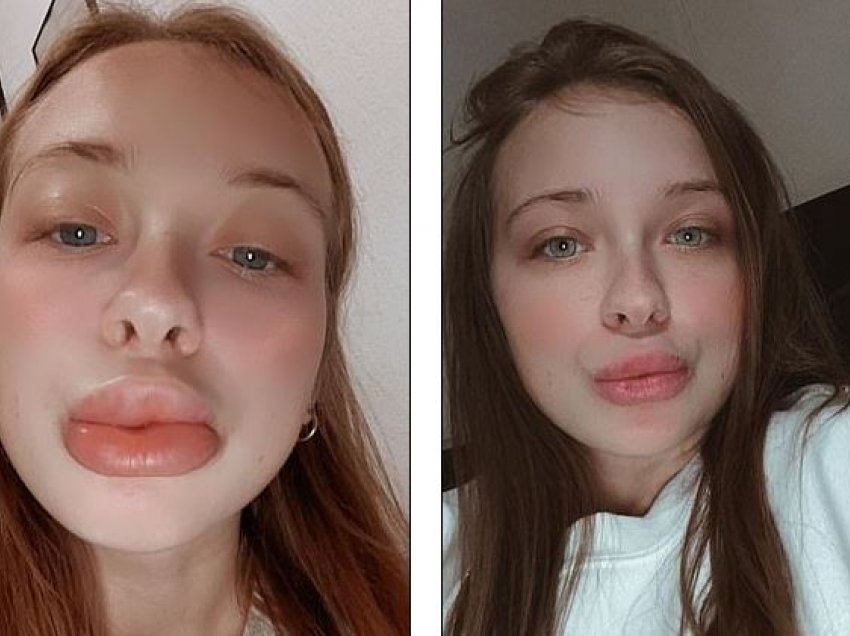Gruaja paralajmëron, mbushja e buzëve që pagoi 100 euro i deformoi fytyrën