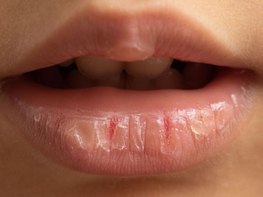 Ja çfarë u ndodh buzëve tuaja kur përdorni balsam shumë shpesh