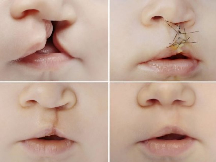 Sindroma e buzës “lepur”: a mund të kapet në kohë gjatë shtatzënisë, cilat janë trajtimet e duhura?