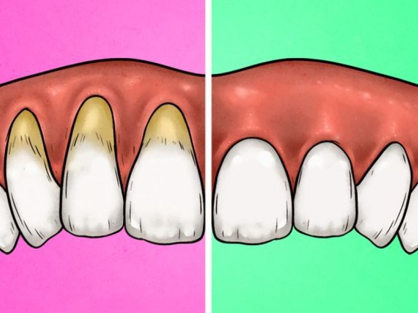 Këto shenja tregojnë se mënyra si i lani dhëmbët po i dëmton ata