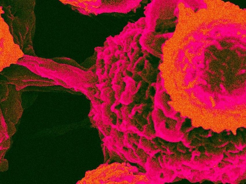 Zbulohet proteina që lidh të gjitha llojet e tumoreve