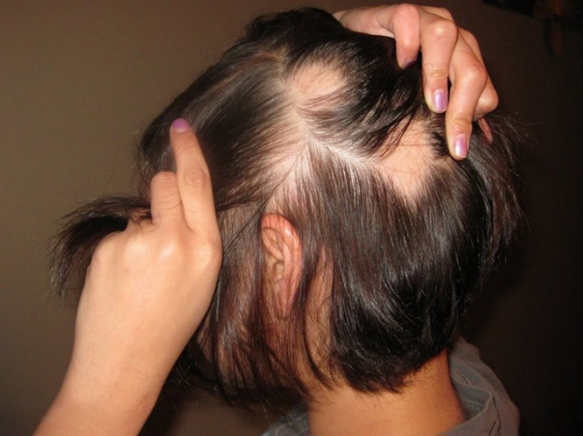 Mënyra natyrale për trajtim të rënies së flokëve
