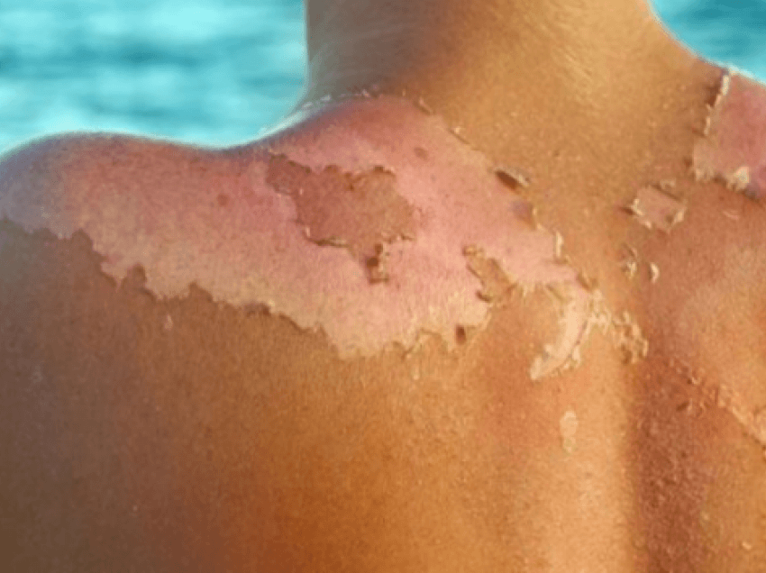 Metodat efikase për trajtimin e lëkurës së djegur nga dielli