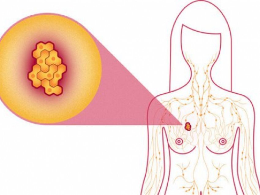 4 shenjat e kancerit të gjirit që s'kanë lidhje me dhimbjet