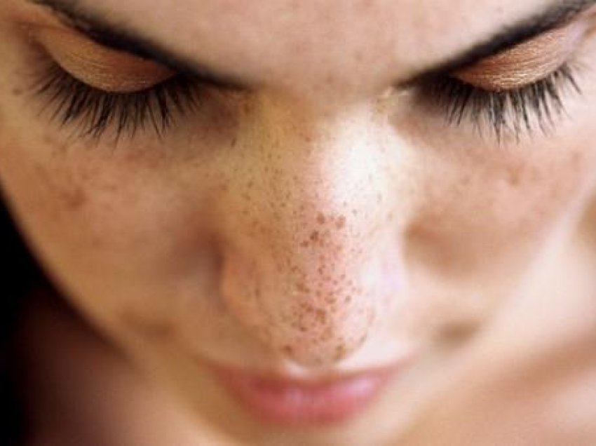 6 gjëra që shkaktojnë njolla të errëta në fytyrë