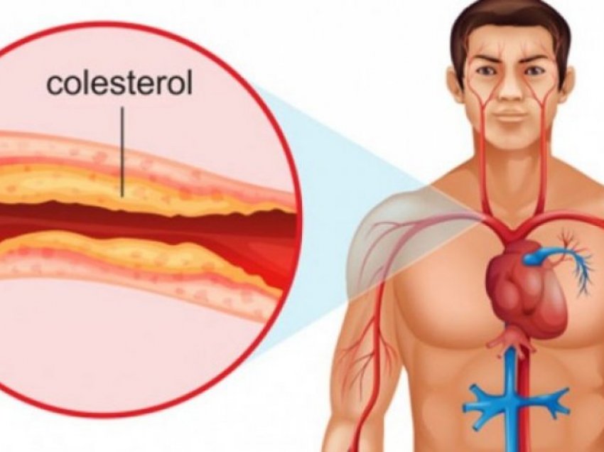 Kolesteroli i lartë, por edhe mungesa e tij, janë të dëmshëm