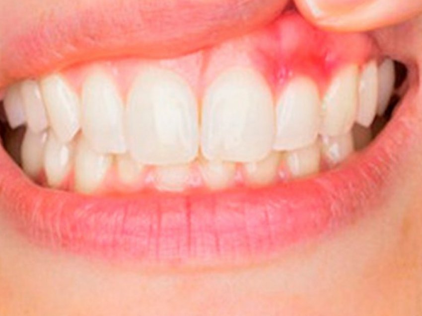 Gjakderdhja nga mishi i dhëmbëve mund të jetë një shenjë e mungesës së kësaj vitamine
