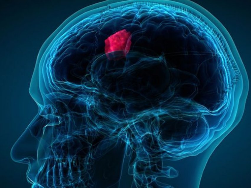 Tumori në tru: Shtatë simptoma që duhet të njihen 