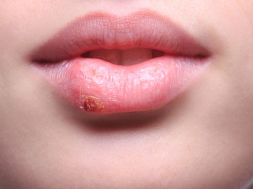 Herpsesi në buzë: Metoda parandalimi dhe trajtimi