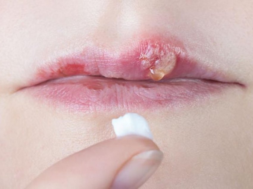 Metoda parandalimi dhe trajtimi i herpesit në buzë