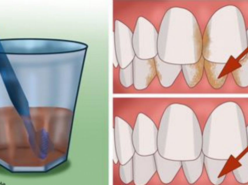Mos e injoroni rrjedhjen e gjakut nga mishrat e dhëmbëve
