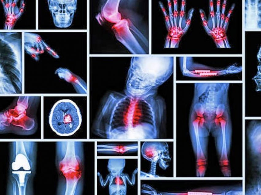 Njihuni me mënyrat si të përdorni qepët kundër artritit, reumatizmës dhe osteoporozës